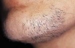 Case #3068 - IPL Hair Removal, before photograph