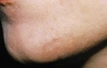 IPL Hair Removal patient result