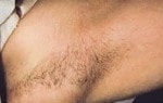 Case #3072 - IPL Hair Removal, before photograph