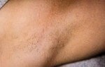 Case #3072 - IPL Hair Removal after photograph