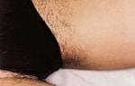 Case #3076 - IPL Hair Removal, before photograph