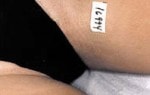 Case #3076 - IPL Hair Removal after photograph