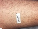 Case #3080 - IPL Hair Removal, before photograph