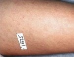 Case #3080 - IPL Hair Removal after photograph