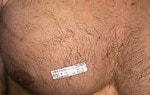 Case #3084 - IPL Hair Removal, before photograph