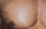 Case #3084 - IPL Hair Removal after photograph
