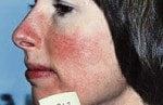Case #3093 - IPL Photo Rejuvenation, before photograph