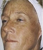 Case #3097 - IPL Photo Rejuvenation, before photograph