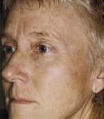 Case #3097 - IPL Photo Rejuvenation after photograph
