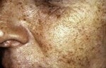 Case #3101 - IPL Photo Rejuvenation, before photograph