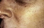 Case #3101 - IPL Photo Rejuvenation after photograph