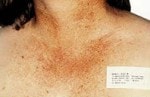 Case #3105 - IPL Photo Rejuvenation, before photograph