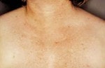 Case #3105 - IPL Photo Rejuvenation after photograph