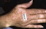 Case #3109 - IPL Photo Rejuvenation, before photograph