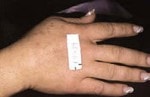 Case #3109 - IPL Photo Rejuvenation after photograph