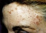 Case #3113 - IPL Photo Rejuvenation, before photograph