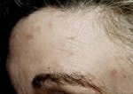 Case #3113 - IPL Photo Rejuvenation after photograph