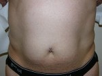 Case #3310 - Body Contouring, before photograph