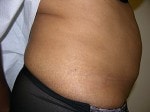 Case #3314 - Body Contouring, before photograph