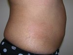 Case #3314 - Body Contouring after photograph