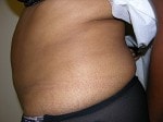 Case #3314 - Body Contouring, before photograph