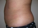 Case #3314 - Body Contouring, after photograph