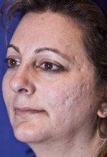 Case #3455 - Laser Skin Resurfacing, before photograph