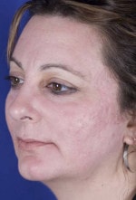 Laser Skin Resurfacing patient result