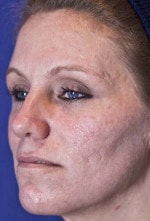 Case #3459 - Laser Skin Resurfacing, before photograph