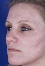 Case #3459 - Laser Skin Resurfacing after photograph