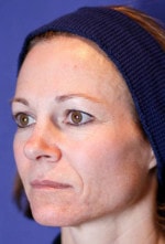 Case #3463 - Laser Skin Resurfacing, before photograph