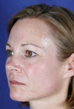 Case #3463 - Laser Skin Resurfacing after photograph
