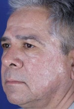 Case #3467 - Laser Skin Resurfacing after photograph