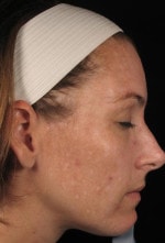 Case #3471 - Laser Skin Resurfacing, before photograph