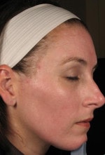 Case #3471 - Laser Skin Resurfacing after photograph
