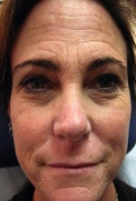 Case #3475 - Laser Skin Resurfacing, before photograph