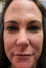 Case #3475 - Laser Skin Resurfacing after photograph