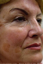 Case #3479 - Laser Skin Resurfacing, before photograph