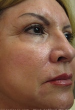 Case #3479 - Laser Skin Resurfacing after photograph