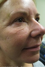 Case #3484 - Laser Skin Resurfacing, before photograph