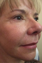 Case #3484 - Laser Skin Resurfacing after photograph