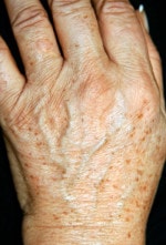 Case #3488 - Laser Skin Resurfacing, before photograph