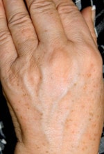 Case #3488 - Laser Skin Resurfacing after photograph