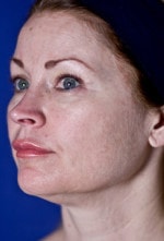 Case #3492 - Laser Skin Resurfacing, before photograph