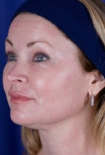 Case #3492 - Laser Skin Resurfacing after photograph