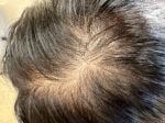 Case #4085 - PRP Hair Restoration Before and After Photos, before photograph