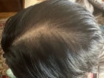 Non-Surgical Procedures patient result