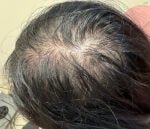 Case #4085 - PRP Hair Restoration Before and After Photos, before photograph