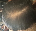 Case #4085 - PRP Hair Restoration Before and After Photos, after photograph
