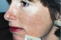 IPL photorejuvenation patient result